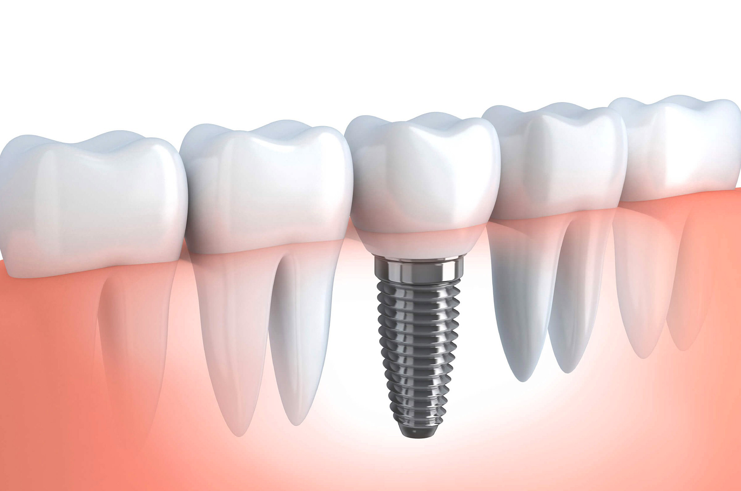 Implante Dentário em Timbó - implante guiado sem cortes na Odontotim