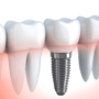 Implante Dentário: Recuperando Sorrisos com a Odontotim