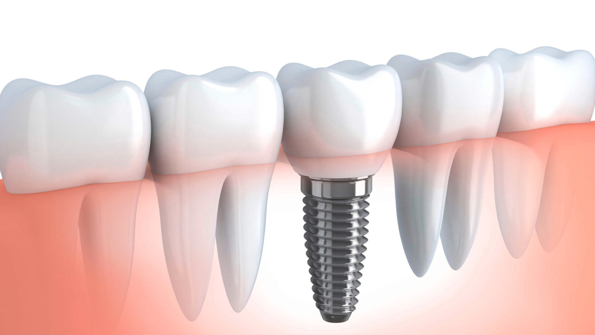 imagem de um implante dentário